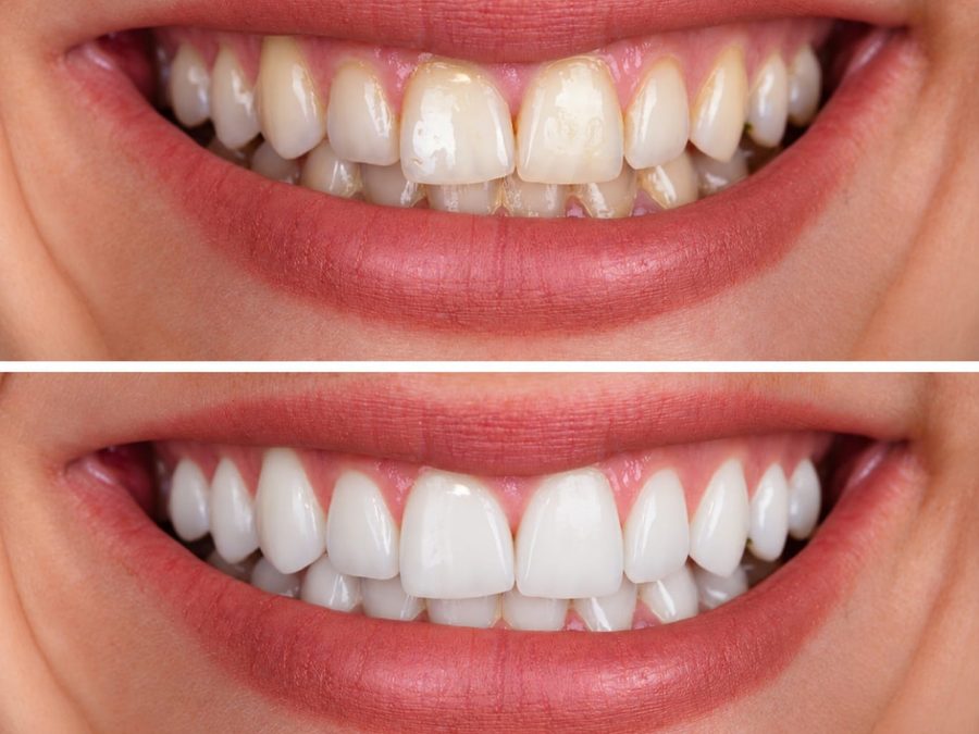 Antes y después de un tratamiento de estética dental