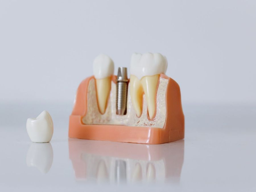 Maqueta de un implante dental con su corona