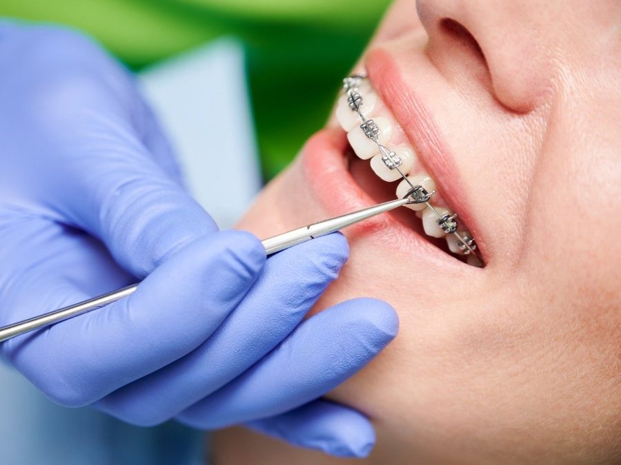 Ortodoncista revisando unos brackets metálicos